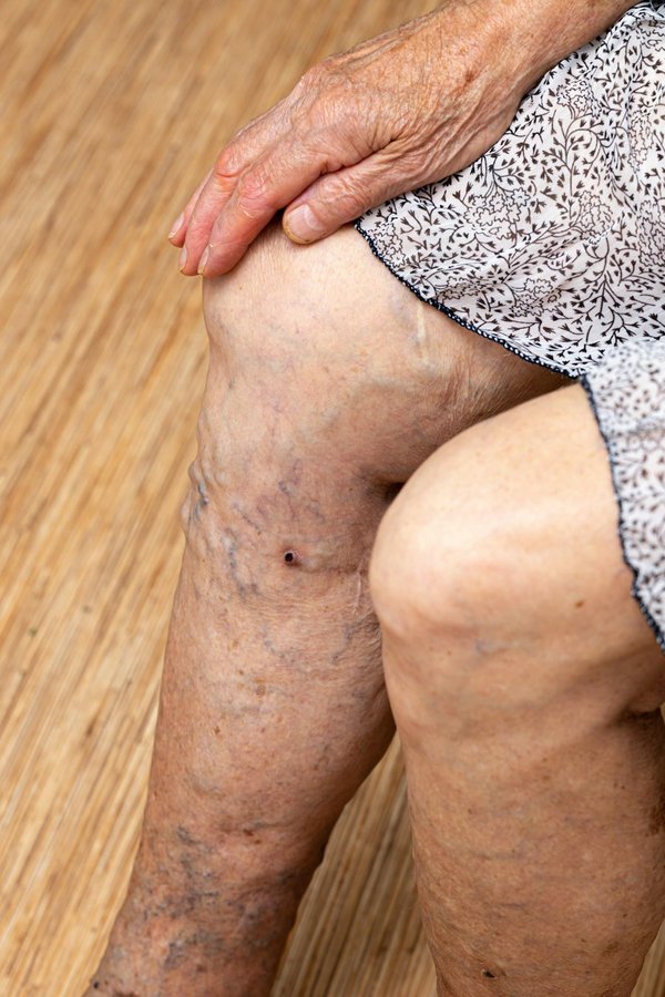 Quels sont les avantages de choisir cette clinique pour le traitement de l'insuffisance veineuse?